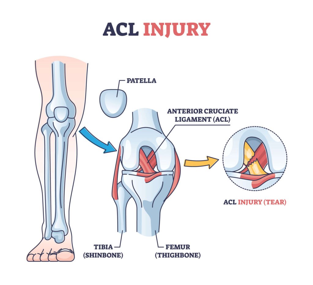 ACL Rehab Physiotherapy Mahadevapura