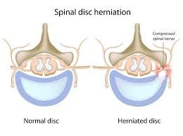 Disc bulge non-surgical treatment in Brookfield