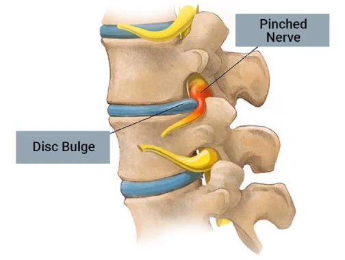 Disc bulge physiotherapy treatment in Whitefield