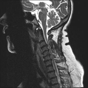 Cervical spondylitis treatment in AECS Layout Bangalore