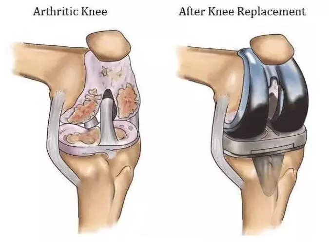 Post operative TKR rehabilitation in Whitefield