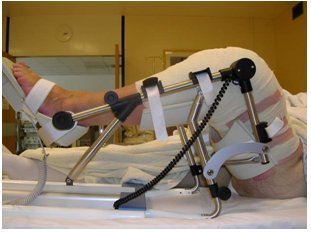 Post operative TKR rehabilitation in Whitefield