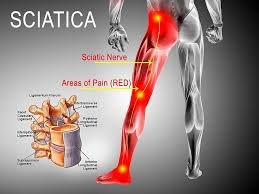 Sciatica nerve pain physiotherapy in Varthur