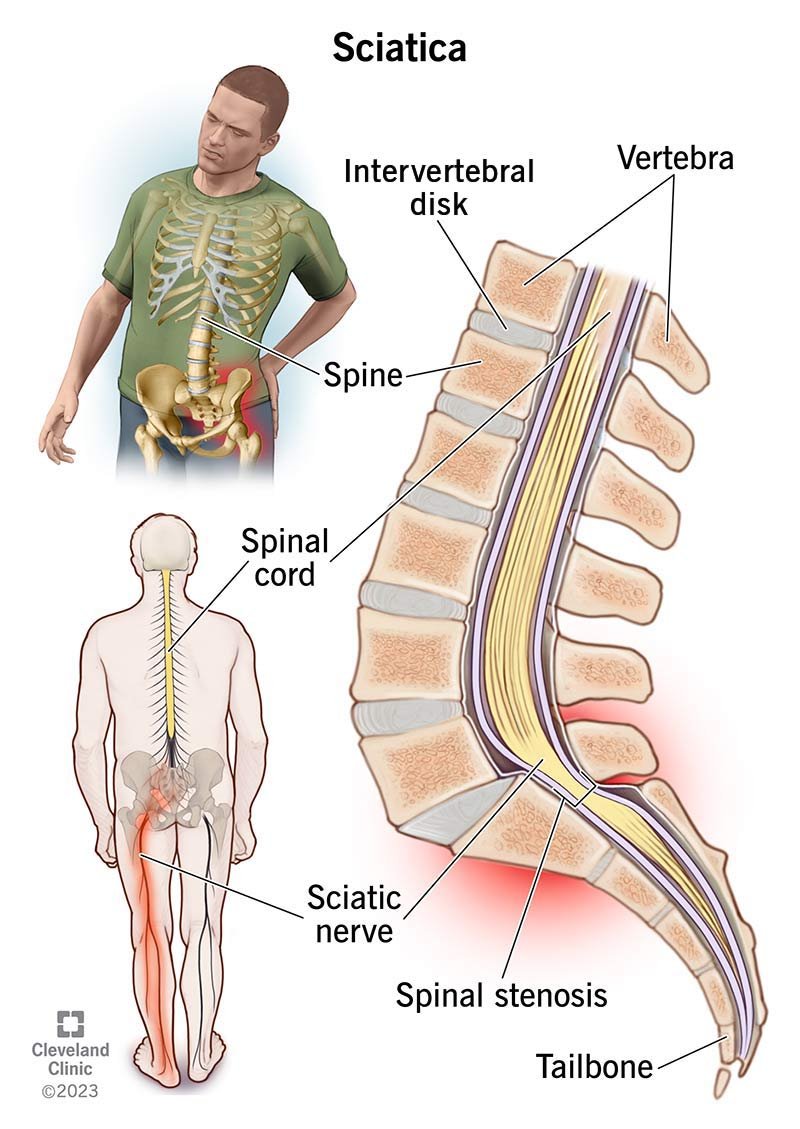 Sciatica pain treatment near Whitefield