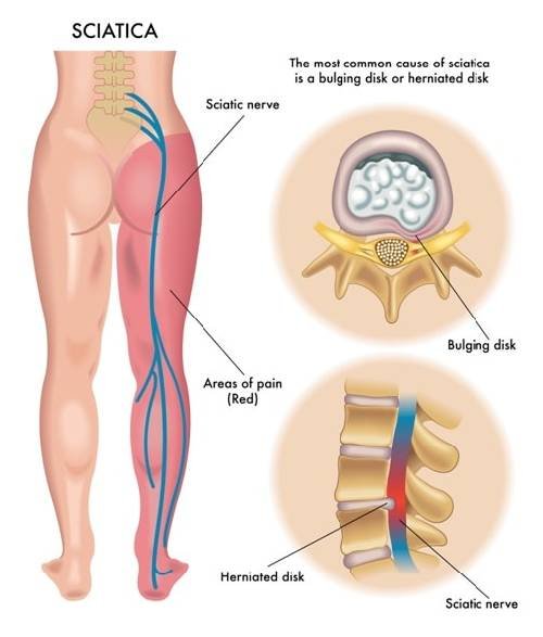 Sciatica pain treatment near Whitefield