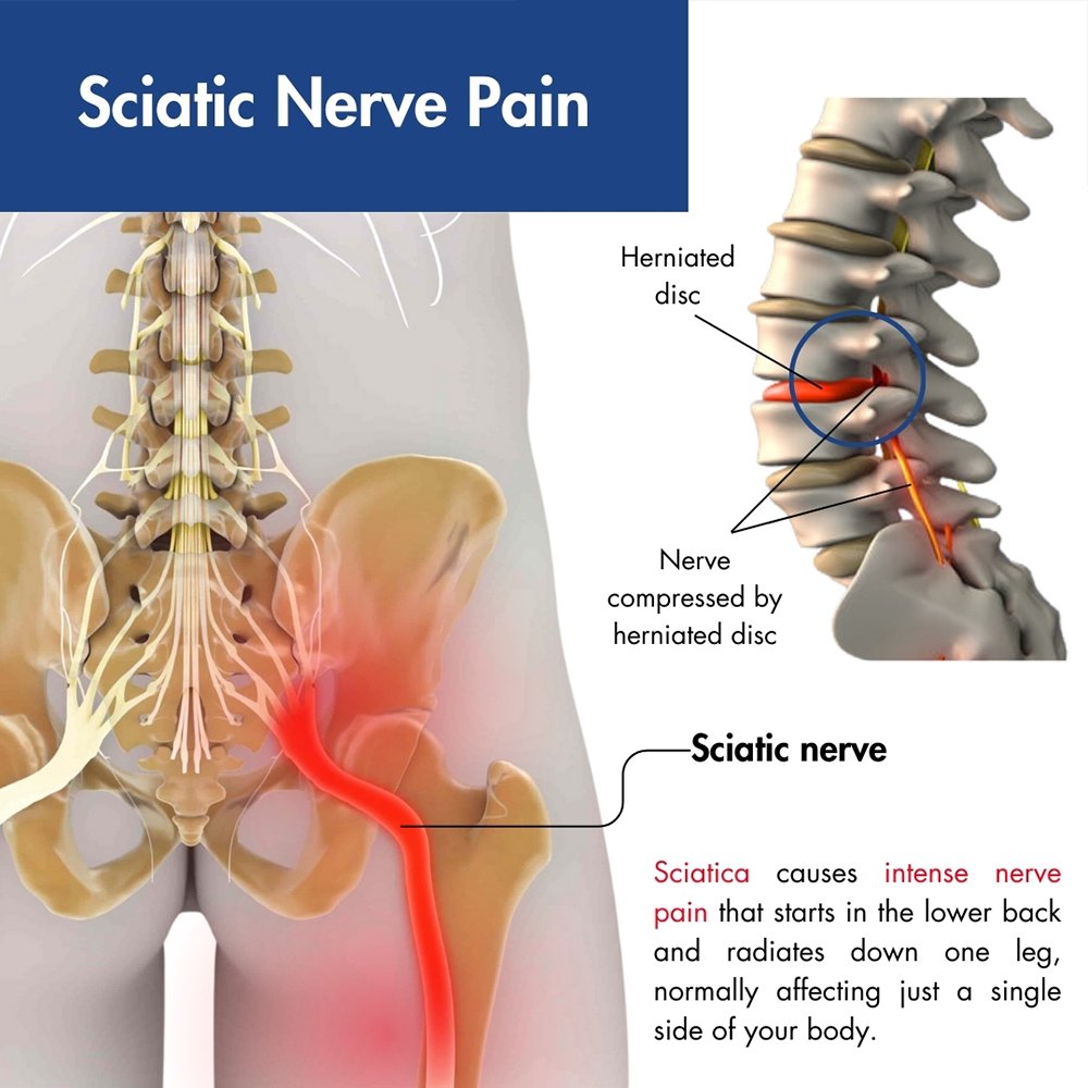 Sciatica pain treatment near Whitefield