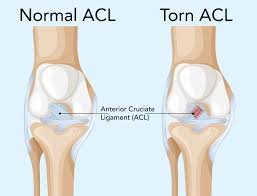 ACL tear rehabilitation in Brookfield