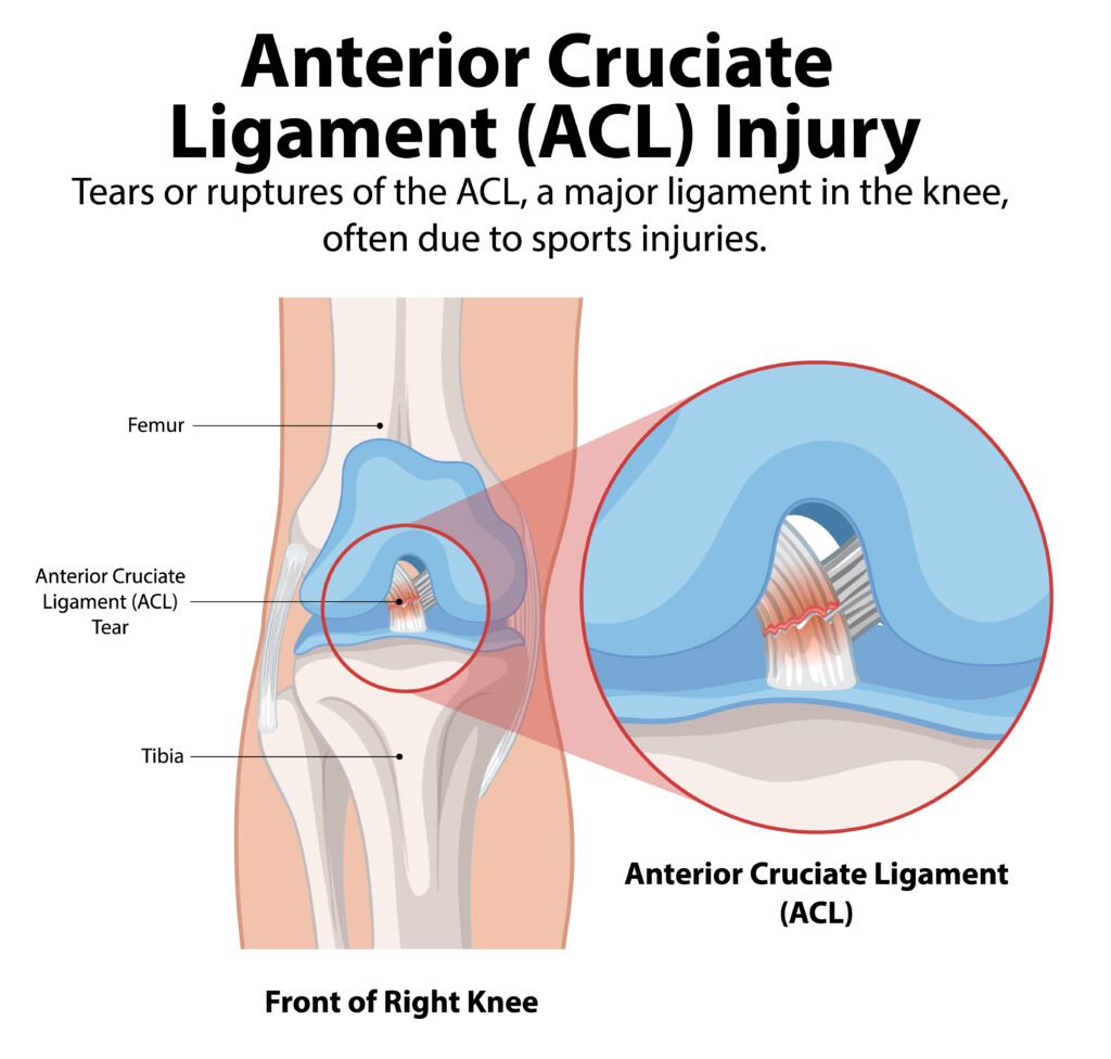 ACL tear rehabilitation in Brookfield
