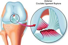 ACL tear rehabilitation in Brookfield