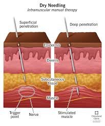 Dry needling therapy in Brookfield