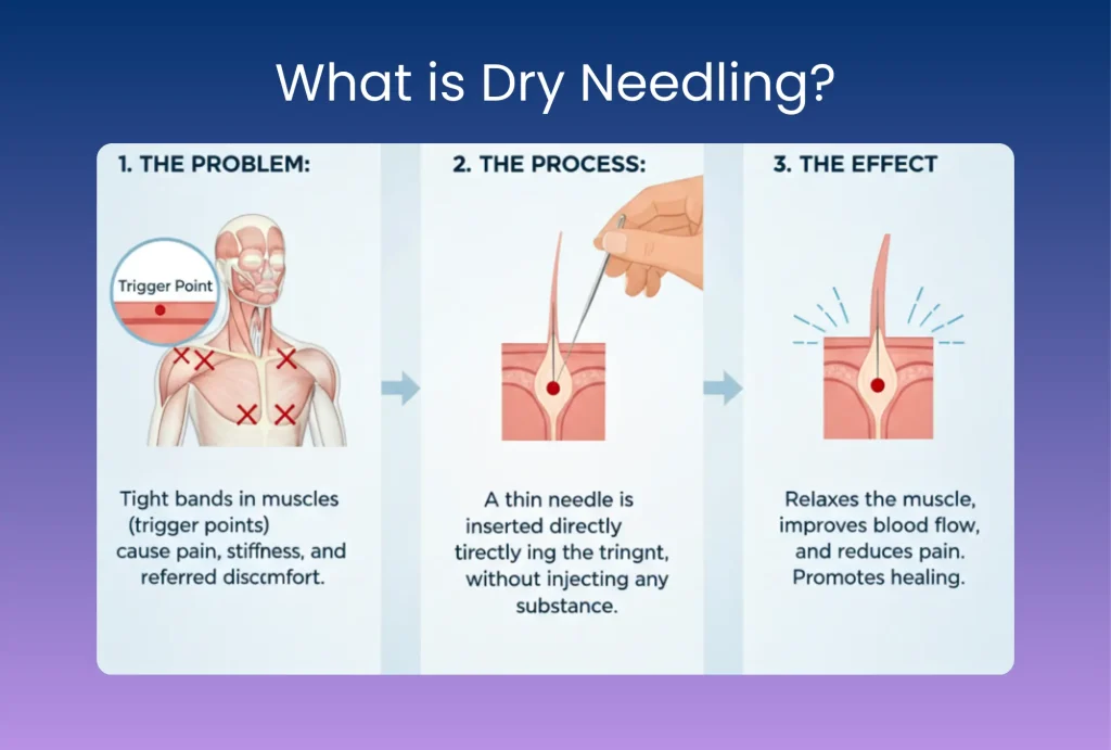 Dry needling therapy in Brookfield
