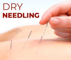 Dry needling therapy in Brookfield