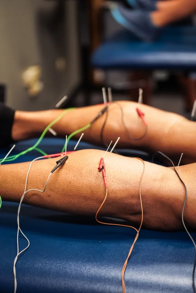 Dry needling therapy in Brookfield