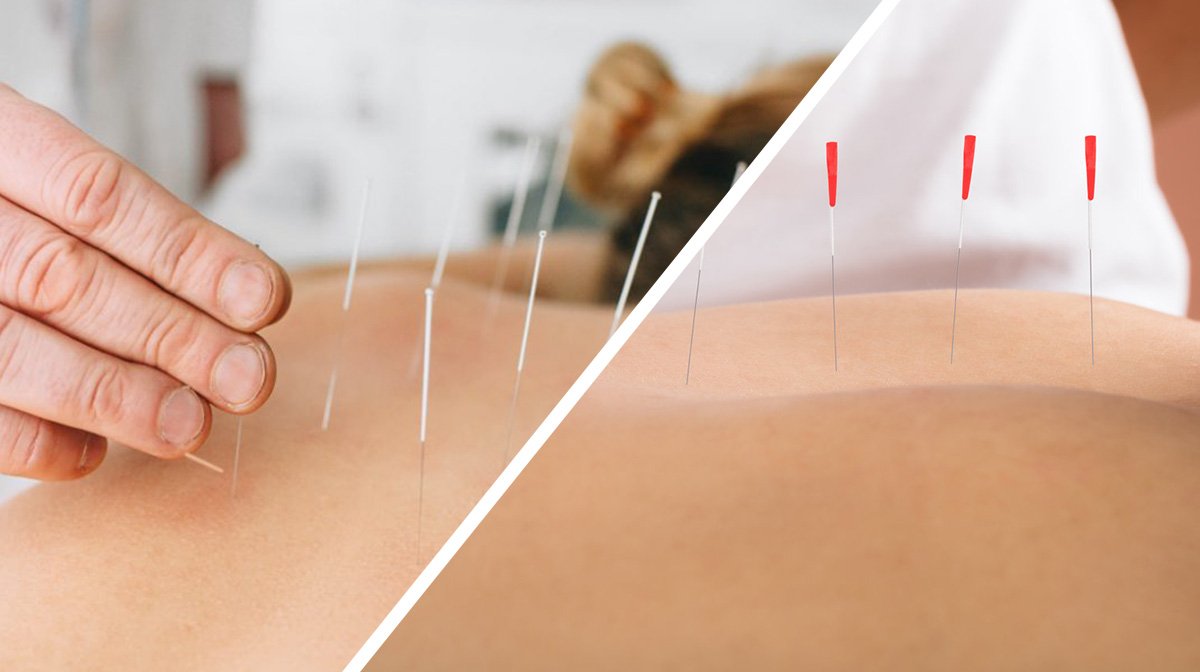 Dry needling treatment near BEML Layout