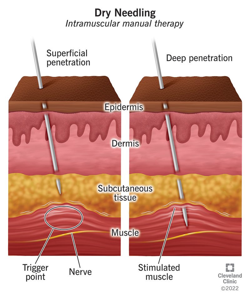 Dry needling treatment near BEML Layout