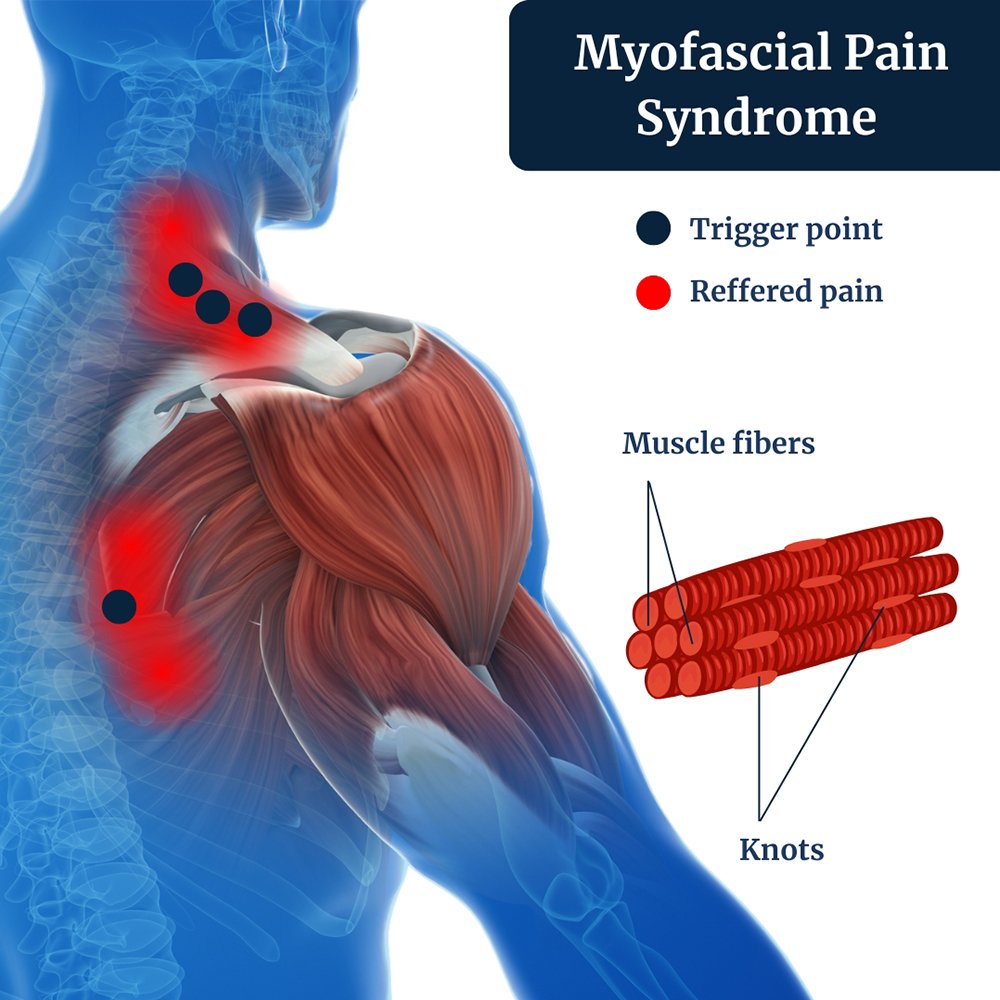 Myofascial trigger point treatment in whitefield