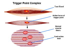 Myofascial trigger point treatment in whitefield
