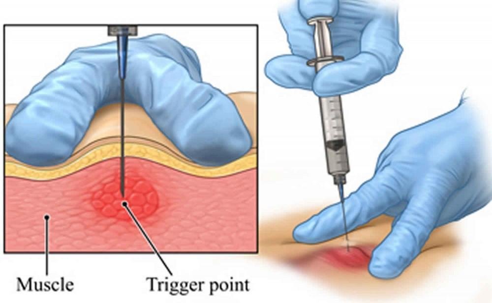 Myofascial trigger point treatment in whitefield
