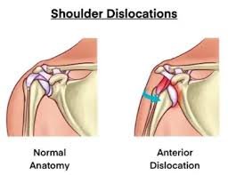 Shoulder dislocation rehabilitation in AECS Layout