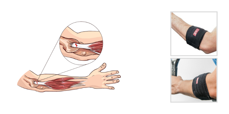 Tennis elbow treatment in Kaggadasapura