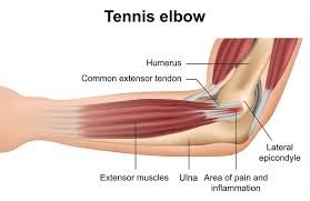 Tennis elbow treatment in Kaggadasapura