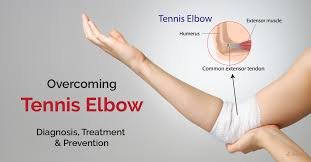 Tennis elbow treatment in Kaggadasapura