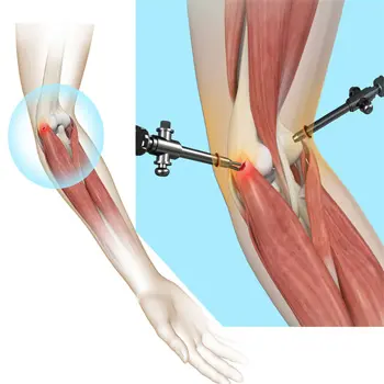Tennis elbow treatment in Kaggadasapura
