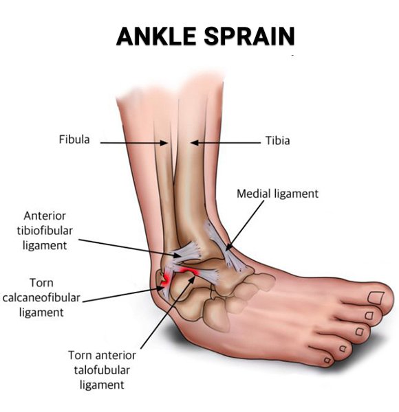 Ankle Sprain Treatment in Marathahalli