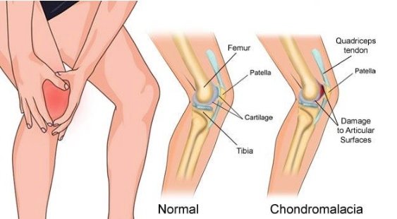 Expert Care for Chondromalacia Patella in Doddenakundi