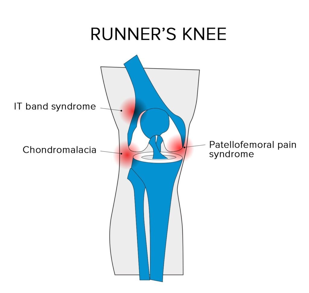 Knee Pain Treatment for Runner’s Knee in Hoodi Bangalore