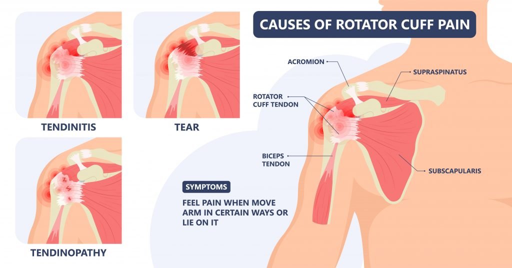 Rotator Cuff Injury Treatment in Mahadevapura