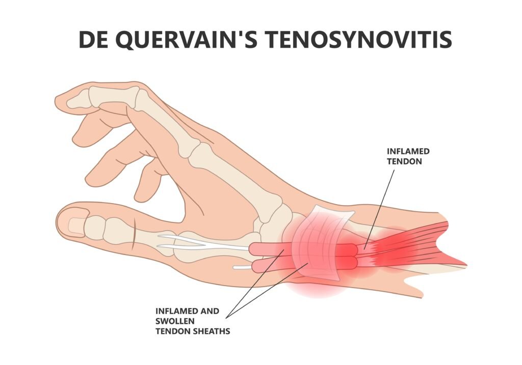 Top Clinic for DQT Wrist Pain Treatment in Kaggdaspura Bangalore