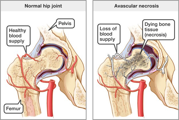 Top Physiotherapy for Avascular Necrosis in Marathahalli Bangalore
