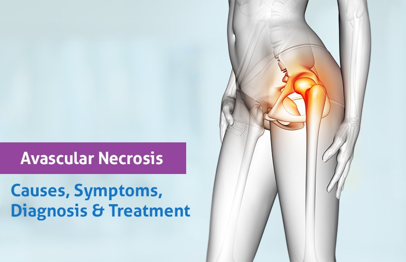 Top Physiotherapy for Avascular Necrosis in Marathahalli Bangalore
