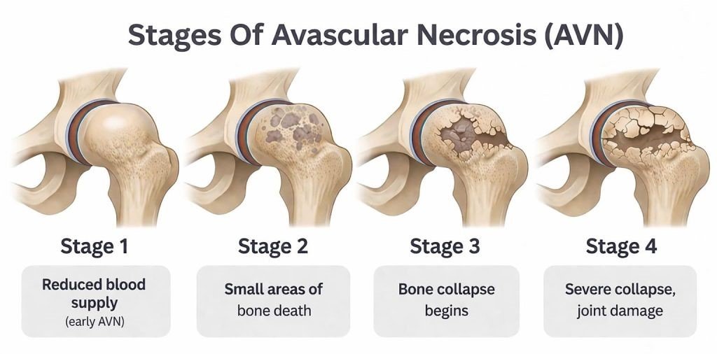 Top Physiotherapy for Avascular Necrosis in Marathahalli Bangalore