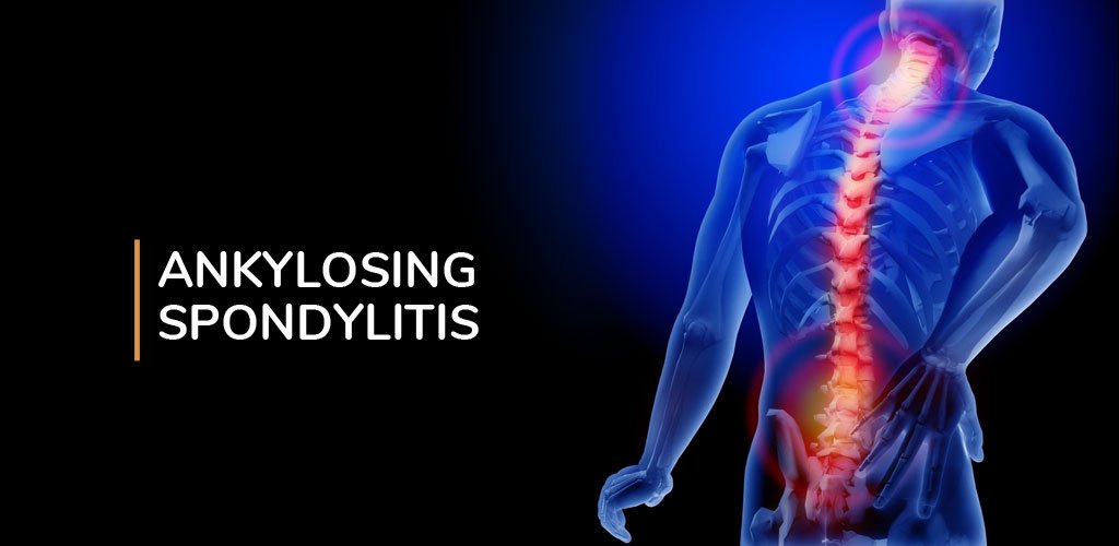 Ankylosing Spondylitis Treatment in Mahadevapura