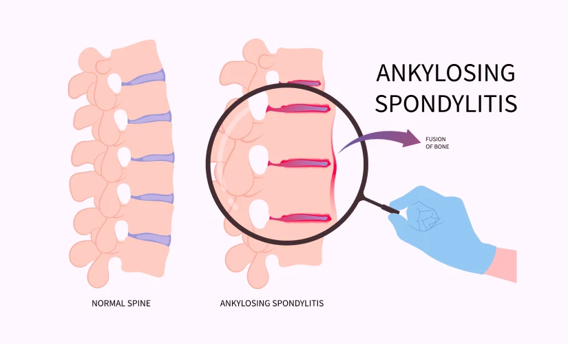Ankylosing Spondylitis Treatment in Mahadevapura