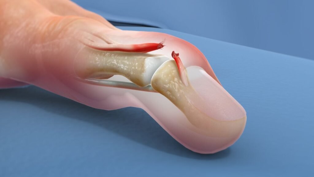 Mallet Finger Treatment in Marathahalli