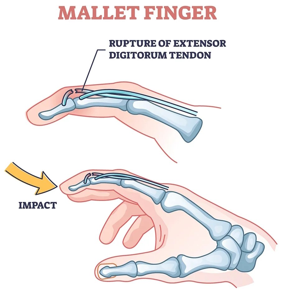 Mallet Finger Treatment in Marathahalli