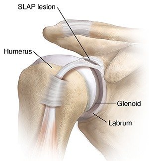 SLAP Tear Treatment in Hoodi Bangalore