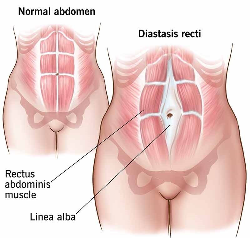 Top Clinic for Diastasis Recti in Hoodi Bangalore