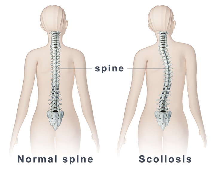 Top Clinic for Scoliosis Rehab in Mahadevapura