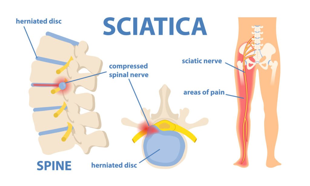 Best Home Exercises for Sciatica in Mahadevapura