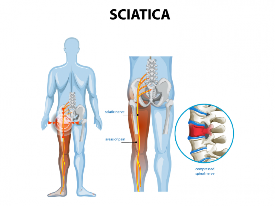 Best Home Exercises for Sciatica in Mahadevapura