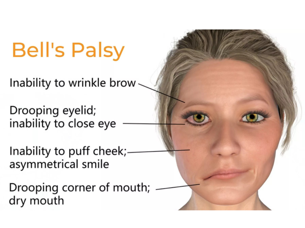 Best Bell's Palsy Rehabilitation in Marathahalli